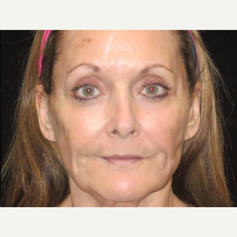 65-74 year old woman treated with Liquid Facelift after 3502977
