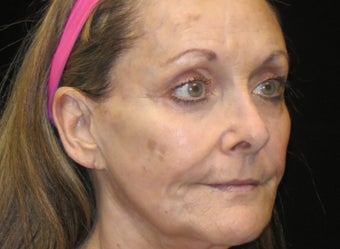 65-74 year old woman treated with Liquid Facelift 3502977