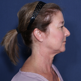55-64 year old woman treated with Neck Lift before 3174862