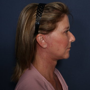 55-64 year old woman treated with Neck Lift after 3174862
