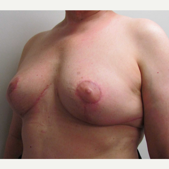 En Bloc Total Capsulectomy with Breast Implant Removal & Breast Lift after 3460816
