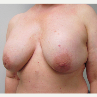En Bloc Total Capsulectomy with Breast Implant Removal & Breast Lift before 3460816