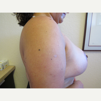 35-44 year old woman treated with Breast Reduction after 3412375