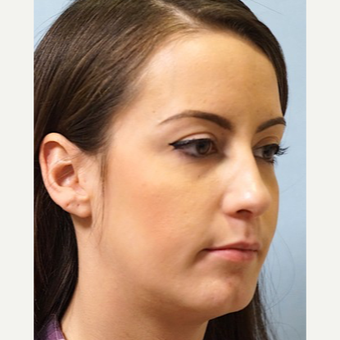 25-34 year old woman treated with Revision Rhinoplasty after 3686791