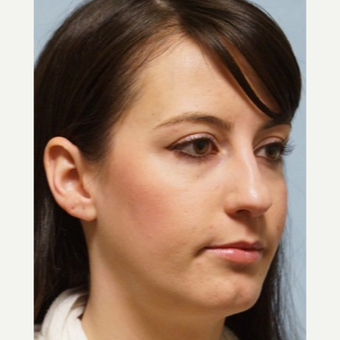 25-34 year old woman treated with Revision Rhinoplasty before 3686791