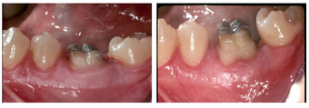 Functioning Crown Lengthening before 1008338