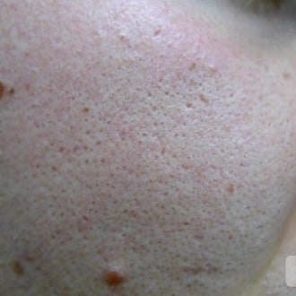Open pores permanent treated with laser before 2155840