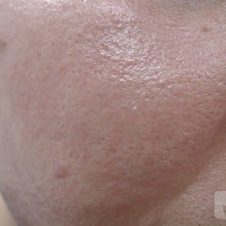 Open pores permanent treated with laser after 2155840