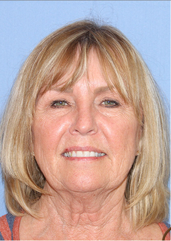 Lower Facelift, Neck Liposuction, Lower Blepharoplasty and Fractional CO2 Laser Resurfacing before 1344089