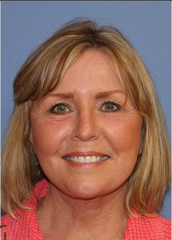 Lower Facelift, Neck Liposuction, Lower Blepharoplasty and Fractional CO2 Laser Resurfacing after 1344089