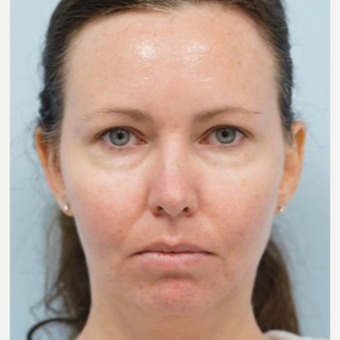 35-44 year old woman treated with Radiesse before 3710890