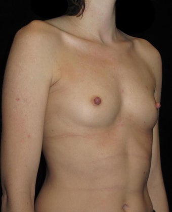 31 year old woman with asymmetry treated with Breast Augmentation 3093688