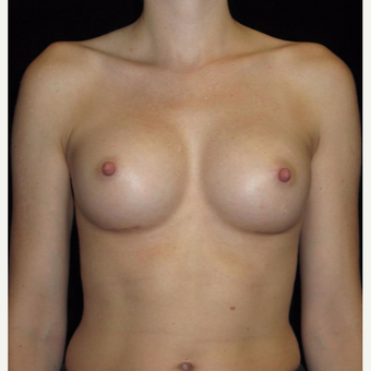 31 year old woman with asymmetry treated with Breast Augmentation after 3093688