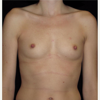 31 year old woman with asymmetry treated with Breast Augmentation before 3093688