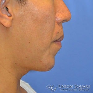 Non Surgical Chin Augmentation using Radiesse dermal filler. after 1631417