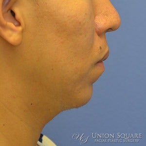 Non Surgical Chin Augmentation using Radiesse dermal filler. before 1631417