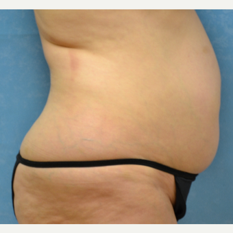 55 year old female liposuction achieved spectacular results before 3731805