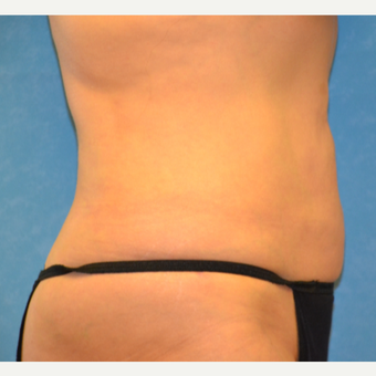 55 year old female liposuction achieved spectacular results after 3731805
