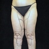 65-74 year old woman treated with Liposuction before 1847032