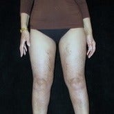 65-74 year old woman treated with Liposuction after 1847032