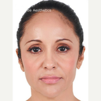Juvederm for Lower Face after 2960479