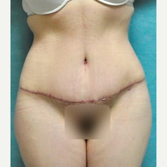Circumferential Tummy Tuck after 2340390