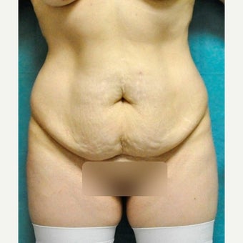 Circumferential Tummy Tuck before 2340390