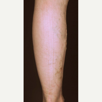 55-64 year old woman treated with Vein Treatment before 3537682