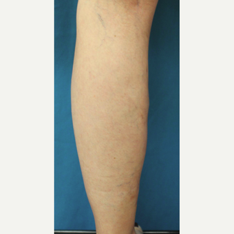 55-64 year old woman treated with Vein Treatment after 3537682