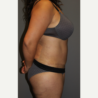 45-54 year old woman treated with Tummy Tuck after 3129182
