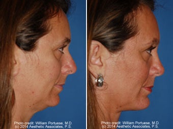 Neck Liposuction before 1389719