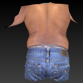 35-44 year old man treated with Liposuction before 3783755