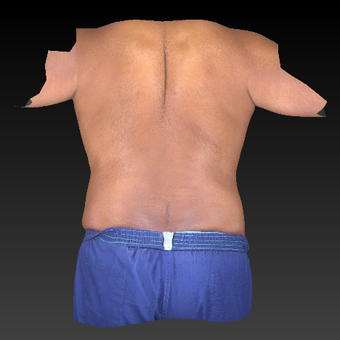 35-44 year old man treated with Liposuction after 3783755