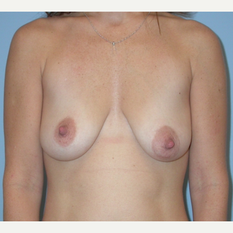 25-34 year old woman treated with Breast Implants before 3070967