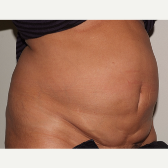 A 60 something has a tummy tuck before 3109579