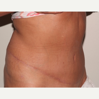 A 60 something has a tummy tuck after 3109579