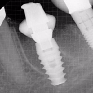 Molar replace with dental implants after 3696459