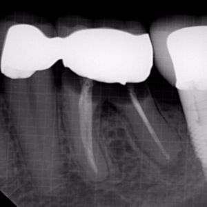 Molar replace with dental implants before 3696459