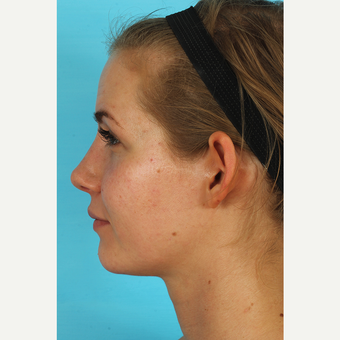 25-34 year old woman treated with Rhinoplasty after 3629425