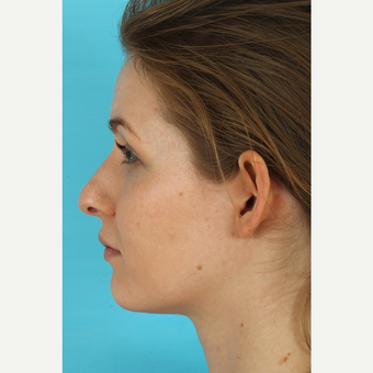 25-34 year old woman treated with Rhinoplasty before 3629425