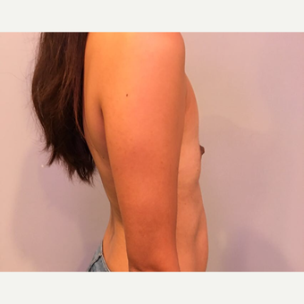 35-44 year old woman treated with Breast Augmentation before 3725997