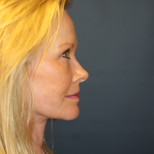 55-64 year old woman treated with Facelift after 3554118