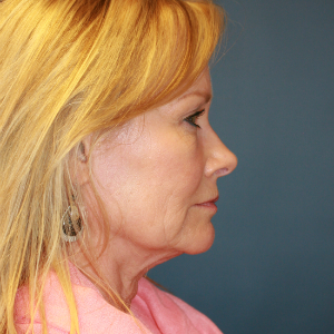 55-64 year old woman treated with Facelift before 3554118