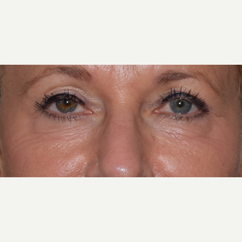 45-54 year old woman treated with Radiesse for under eye aging before 3657464