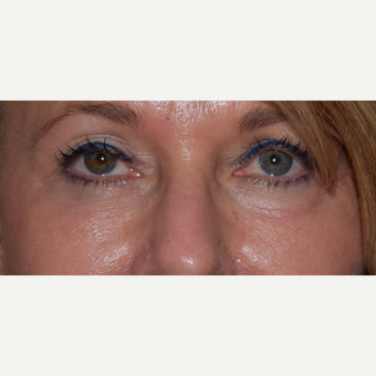 45-54 year old woman treated with Radiesse for under eye aging after 3657464