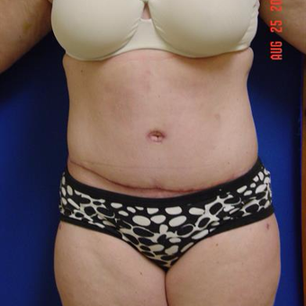 35-44 year old woman treated with Tummy Tuck after 3288383