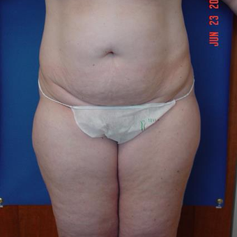 35-44 year old woman treated with Tummy Tuck before 3288383