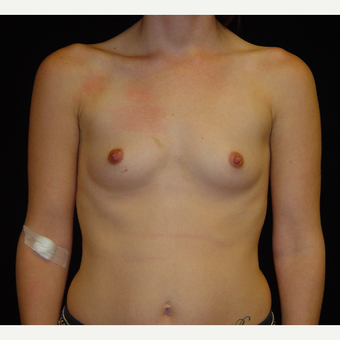 25-34 year old woman treated with Breast Augmentation before 3808913
