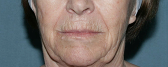 Wrinkle Reduction with Laser Resurfacing before 1064651