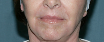 Wrinkle Reduction with Laser Resurfacing after 1064651